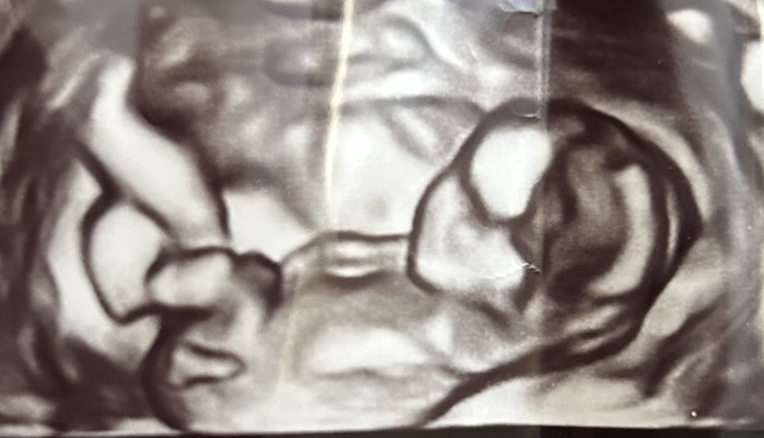 4D ultrasound of Baby Boy White with an arm resting over his face