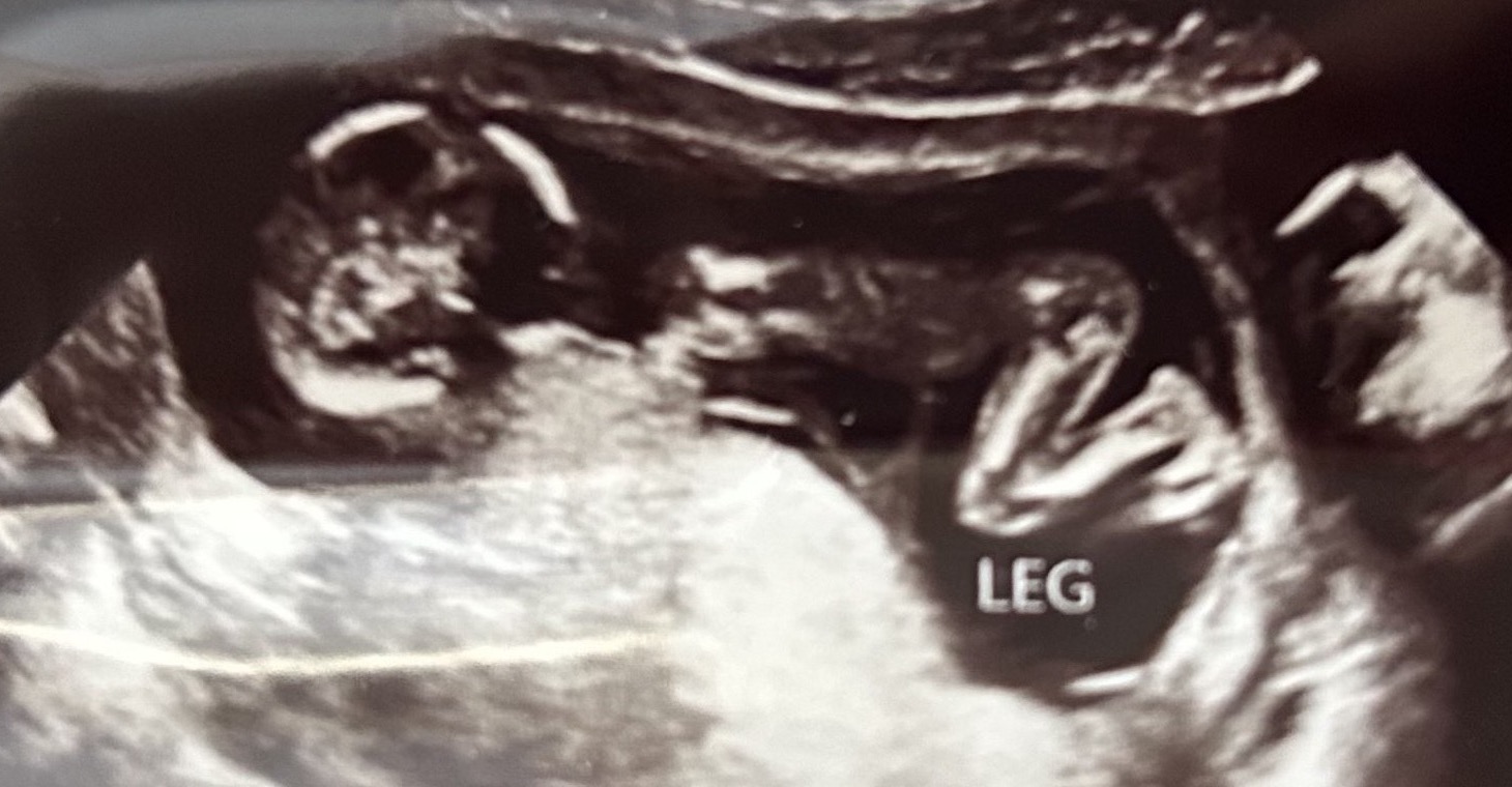 Ultrasound of Baby Boy White in April, with a tiny leg labeled on the scan