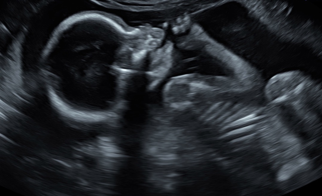 Ultrasound profile of Baby Boy White from the twenty-week scan
